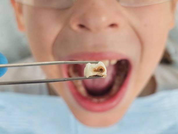 Best Emergency Treatment for Oral Infections in Marshalltown, IA
