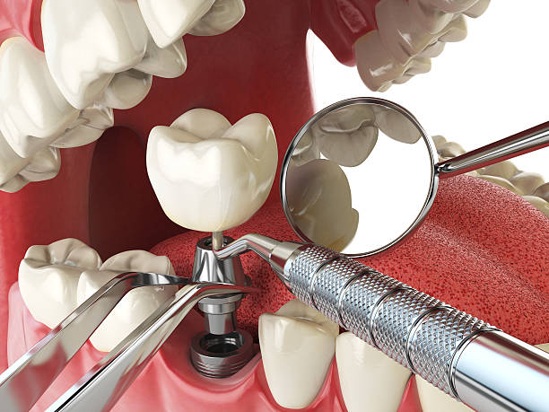 Best Emergency Dental Care for Sports Injuries in Marshalltown, IA